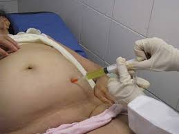 Điều trị bệnh xơ gan